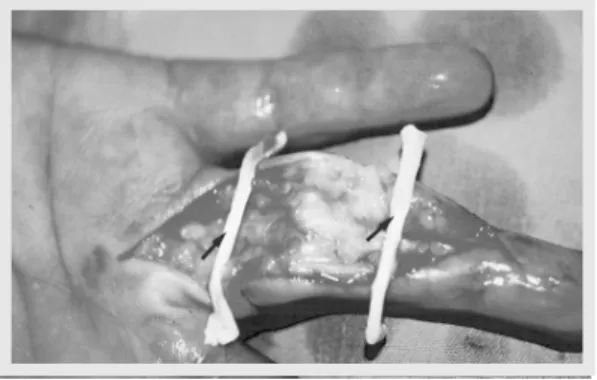 Figure 4 - Rod suture identified with the stump of the