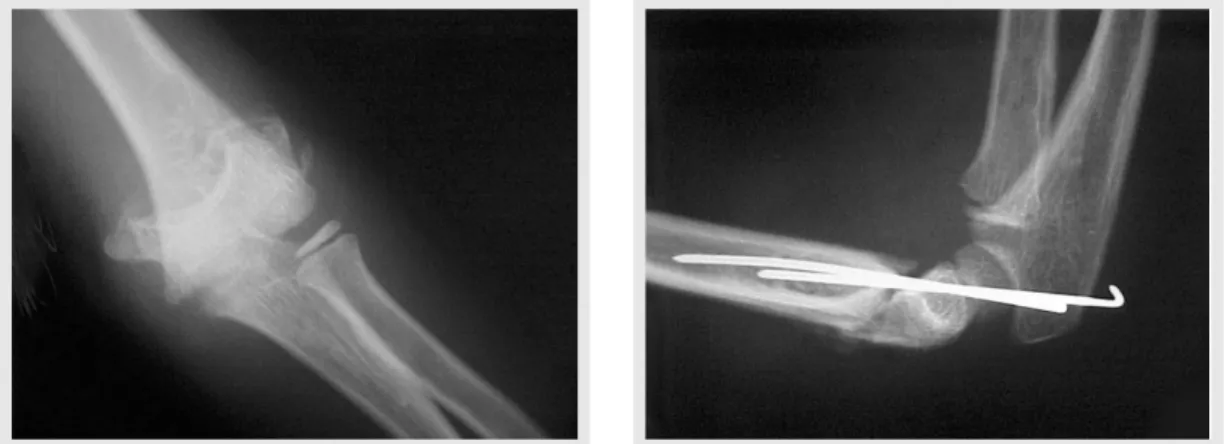 Figura 3 - Raio X - AP. Figure 3 - X-Rays - AP.