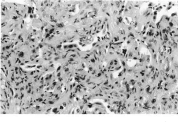 Fig. 2 – Proliferação vascular com presença de células  endoteliais atípicas  ( 400X )