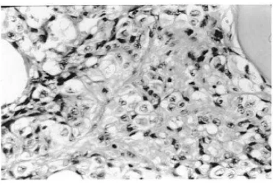 Fig. 4 – Angiossarcoma epitelióide, simulando  carcinoma ( 400X )