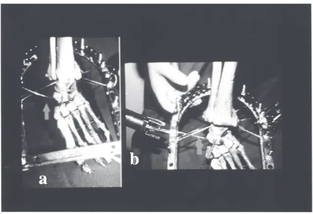 Fig.  4a - Seen previous it shows passage of the 3° thread in the navicular and cubóide