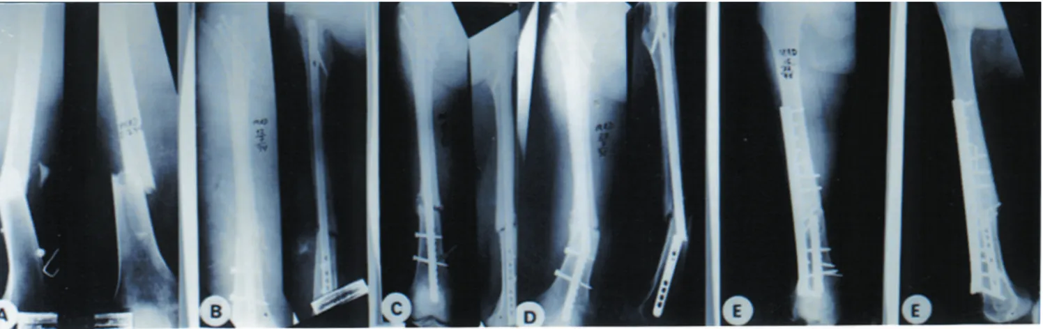 Figura 5 -  Fratura do 1/3 distal do fêmur em paciente de 19 anos de idade, vítima de acidente; A) Pré- operatório; B) Pós-operatório