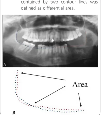Figure 7:   A) postoperative panoramic radiogra- radiogra-phy with symmetrical jaw measurement  using image analysis