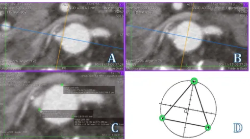 Fig. 2 - Acima: A – Tangente traçada a partir da projeção da artéria renal direita. B –  Posicionamento intraluminal para inicio da marcação espacial