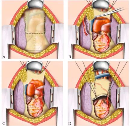 Fig. 1 - (A, B, C e B) Desenho mostra detalhes da abertura do pericárdio e  tunelização através da gordura mediastinal para proteção da ATID