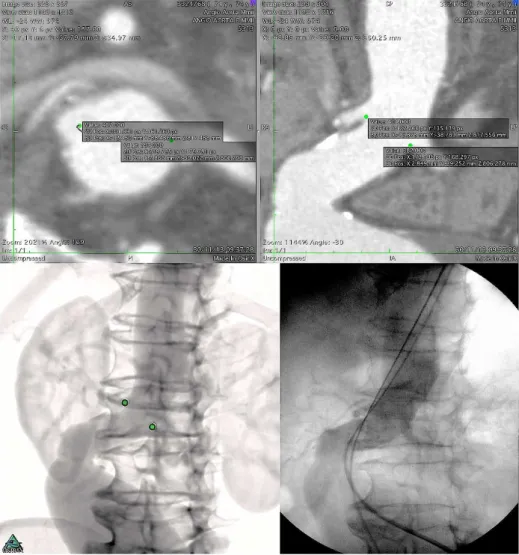 Fig. 1 - Acima - Marcações ostiais das artérias renais em projeção axial, com visualização auxiliar  em corte longitudinal (à direita).