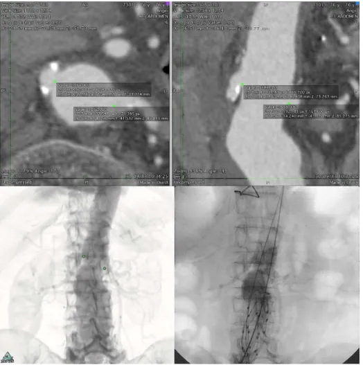 Fig. 2 - Acima - Marcações ostiais das artérias renais em projeção axial, com visualização auxiliar  em corte longitudinal (à direita).