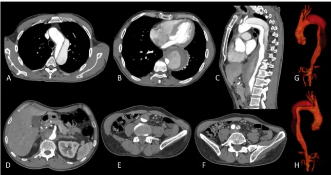 Fig. 2 - Zonas de ancoragem do aneurisma torácico segundo  classificação de Ishimaru e Mitchell