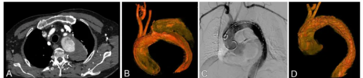 Fig. 3 - Enxerto carotídeo- subclávia esquerdo com ancoramento da prótese em zona 2.  A=Angiotomografia  em corte axial demonstrando volumoso aneurisma torácico sem zona de ancoragem proximal