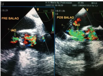 Fig. 4 – Ecocardiograma transesofágico demonstrando aumento da  insuficiência aórtica após valvoplastia por cateter-balão