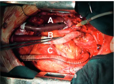 Fig. 2 – A: cânula do átrio direito. B: cânula da aorta ascendente.  C: cânula da artéria pulmonar