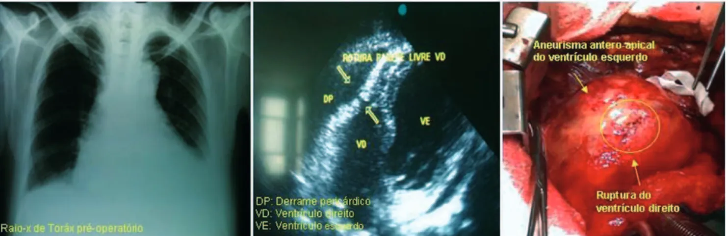 Fig. 1 - Radiografia de tórax, aspecto ecocardiográfico pré-operatório e imagem intraoperatória da ruptura