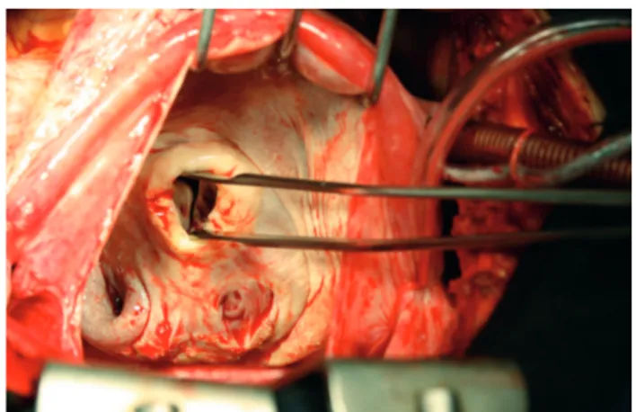 Fig. 3 - Ressecção triangular tangencial do átrio esquerdoFig. 2 - Exploração da valva mitral