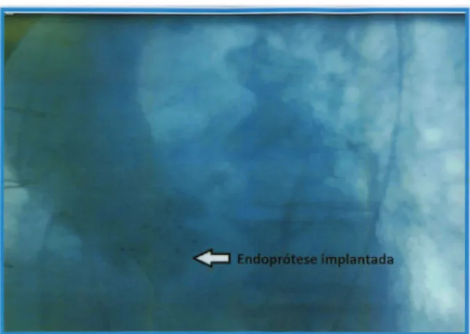 Fig. 2 - Imagem da fluoroscopia demonstrando a ausência de refluxo transvalvar aórtico e o posicionamento da prótese valvar aórtica após o implante transcateter por via transfemoral