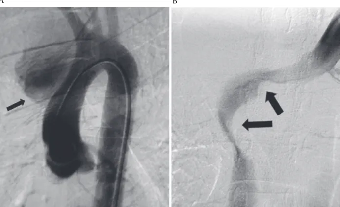 Fig. 1 - Imagem da arteriografia de aorta ascendente e arco aórtico (A) e da venografia da veia braquiocefálica e da VCS (B)