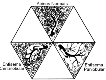 Figura 3.4: diagrama de um lobo do pulm˜ao, ilustrando ´acinos (bagos) normais, enfisema centrilobular e panlobular ( HEARD et al
