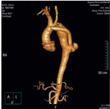 Fig. 1 -  Angiotomografia pré-operatória demonstrando coarctação  da aorta torácica e enxerto aorto-aórtico com pseudoaneurisma  na anastomose distal
