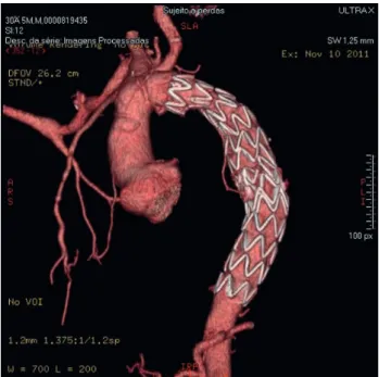 Fig. 2 - Angiotomografia pós-operatória demonstrando correção  da coarctação da aorta e exclusão do pseudoaneurismas com  prótese e endoprótese posicionadas a partir do segmento proximal  da aorta torácica descendente até o segmento médio distal
