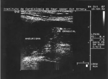 Fig. 1 - Ultrassonografia demonstrando a relação do aneurisma com a artéria braquial direita.