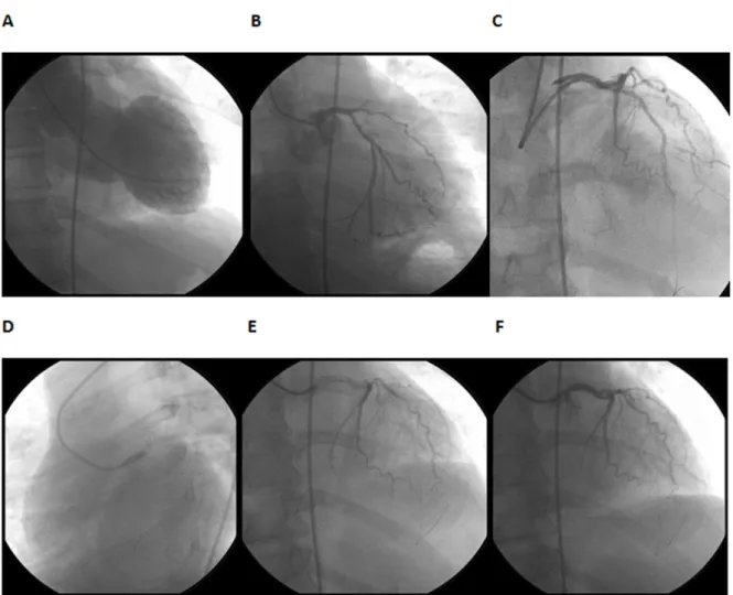 Fig. 1 - A sequência de fotos do CATE mostra: A- um ventrículo esquerdo dilatado e extensamente acinético em parede ântero- ântero-apical; B- a coronariografia antes da intervenção, com oclusão de artéria descendente anterior na origem; C- o momento da dis