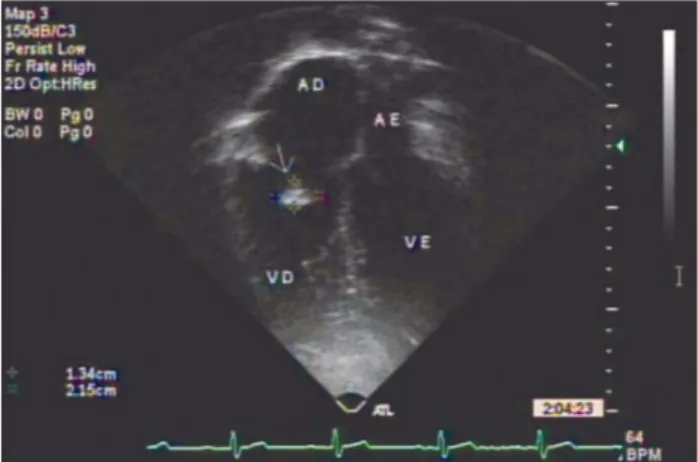 Fig. 2 - Insuficiência tricúspide importante evidenciada pelo ecocardiograma transtorácico