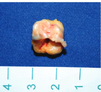 Fig. 3 - Achado cirúrgico observando-se tumor calcificado aderido à cúspide anterior da tricúspide, cúspide septal aderida e sem mobilidade
