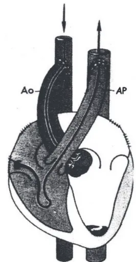 Fig. 1 – Implante heterotópico sem pré ou pós-carga