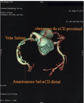 Fig. 2 – Angiografia coronariana por tomografia computadorizada, demonstrando lesão obstrutiva em artéria coronária direita, com enxerto de veia safena em região distal desta artéria pérvio
