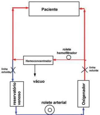 Fig. 1 - Esquema de ultrafiltração modificada. Observar que o paciente está fora de circulação extracorpórea