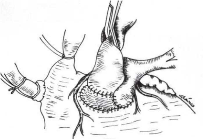 Fig. 2 - Após secção do anel pulmonar e do septo infundibular em direção à comunicação interventricular, realizada ampliação da via de saída do ventrículo esquerdo e fechamento da comunicação interventricular com retalho de pericárdio bovino fixado em glut