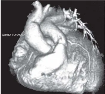 Fig. 4 - Angiotomografia realizada no pós-operatório imediato demonstrou posicionamento adequado do tronco pulmonar dos ramos pulmonares e da aorta ascendente