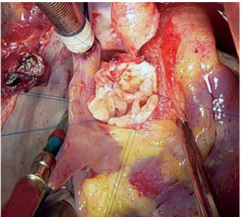 Fig. 2 - Porção aórtica proximal preparada para anastomose, com implante de pericárdio