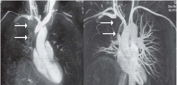 Fig. 1 - Imagens da angioressonância venosa e arterial dos vasos torácicos. As setas indicam a oclusão da veia cava superior e inominada direita causada por uma massa discretamente heterogênea localizada na região do mediastino médio e anterior