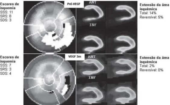 Fig. 3 - Imagem de cintilografia miocárdica de um dos casos estudados. Caso: 54 anos, sexo masculino, hipertenso, diabético, com história prévia de intervenções coronarianas percutâneas e cirurgia de revascularização do miocárdico