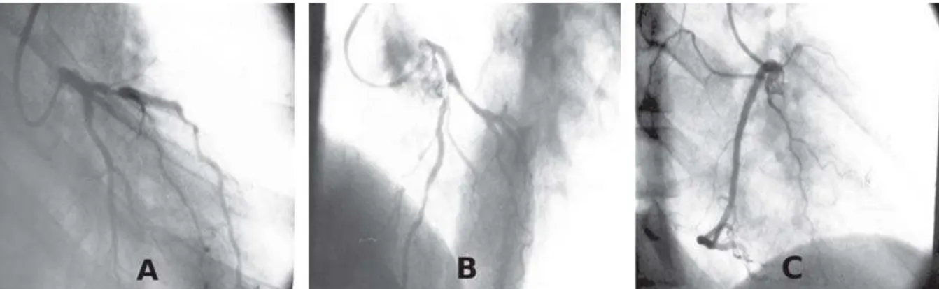 Fig. 1 - Angiografia coronária pré-operatória evidenciando a lesão grave em 1/3 proximal da AIA e CX, sem lesões obstrutivas em OAD (A) e OAE cranial (B)