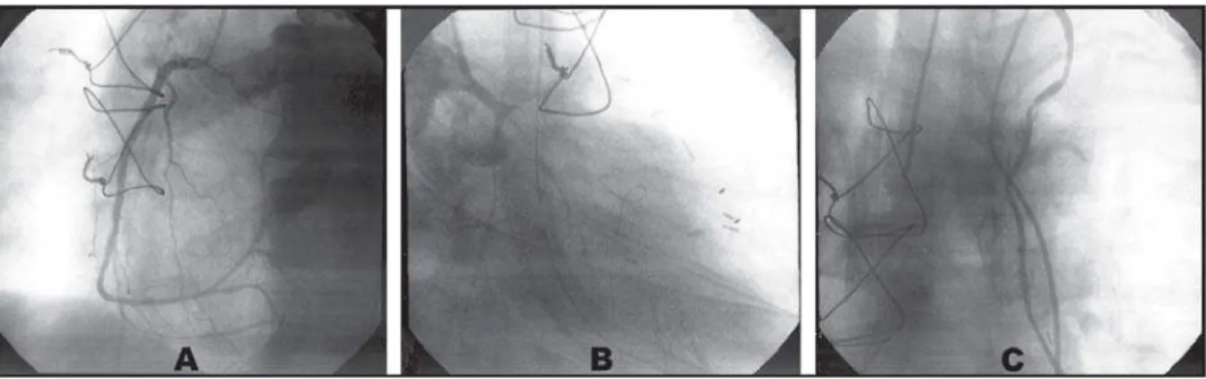 Fig. 3 - Eletrocardiograma no POI (A). Alteração de repolarização inespecífica na parede anterior