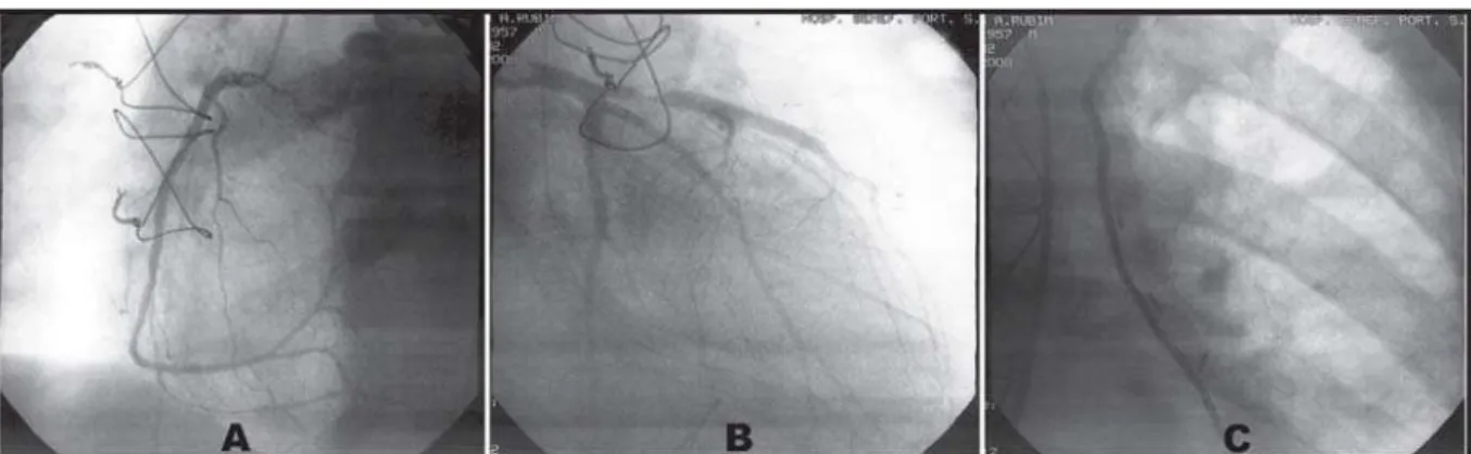 Fig. 5 - Angiografia das artérias coronária direita (A), coronária esquerda (B) e anastomose entre ATIE e AIA (C) com restabelecimento dos calibres usuais das artérias coronárias e seus ramos após vasodilatador