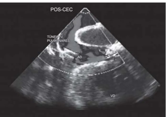 Fig. 3 - Ecocardiograma transesofágico com Doppler, em corte no no nível do átrio direito e o túnel das veias pulmonares após correção da estenose