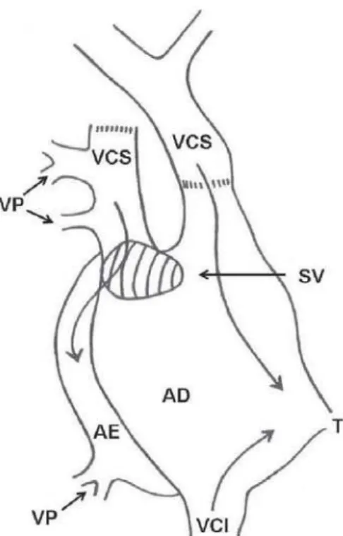 Fig. 5 – Técnica na qual a veia cava superior é seccionada acima da desembocadura da mais alta veia pulmonar anômala e o coto distal ou cefálico é anastomosado no apêndice atrial direito