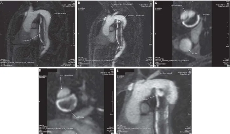 Fig. 1 - Angioressonância de aorta torácica, evidenciando dissecção de aorta após a emergência da artéria subclávia esquerda (Dissecção de Aorta tipo B - Stanford)