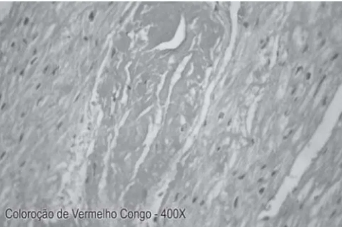 Fig. 4 – Biópsia endomiocárdica com 5 anos de evolução, demonstrando ausência de infiltrado amilóide
