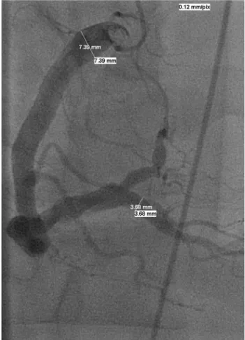Fig. 2 - Angiografia coronária demonstrando as artérias coronárias esquerda, descendente anterior e circunflexa com dilatações consideráveis