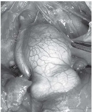 Fig. 1 - Aorta ascendente extremamente hipoplásica em criança portadora de síndrome da hipoplasia do coração esquerdo
