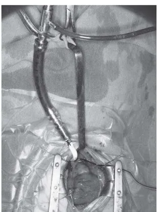 Fig. 2 - Desvio na linha arterial para realizar perfusão retrógrada coronariana regional