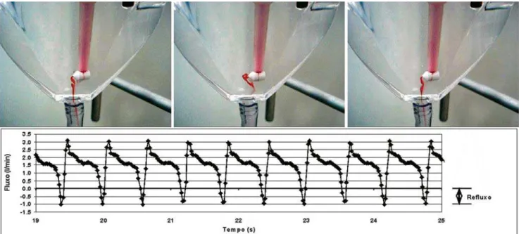 Fig. 5 – Visualização com respectiva medida de refluxo em reservatório de cardiotomia