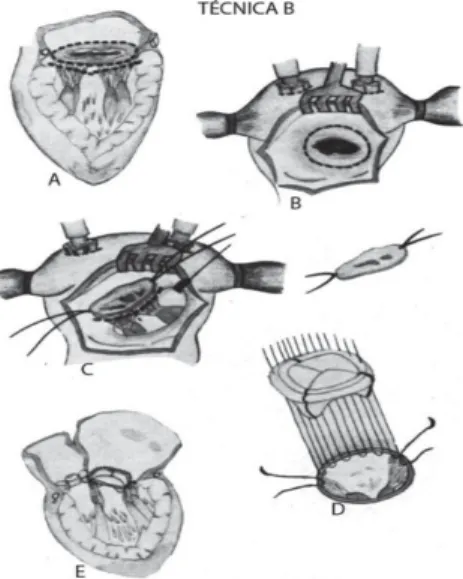 Fig. 1 - Prótese mitral com preservação dos elementos do sistema subvalvar: fixação do topo dos músculos papilares no anel posterior (Évora et al., Rev Bras Cir Cardiovasc
