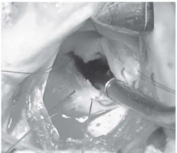 Fig. 1 – Desinserção do folheto posterior do anel. A incisão deve se estender de comissura a comissura