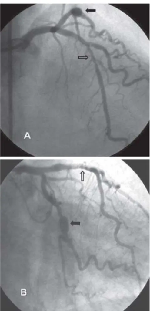 Fig. 1 - Cinecoronariografia em duas projeções, A e B, mostrando aneurisma pós-implante de stent farmacológico em artéria circunflexa (seta negra) e lesão segmentar em artéria descendente anterior (seta branca)