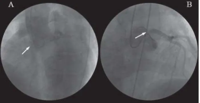 Fig. 1 - Angiografia coronária e aortografia. Angiografia mostrando oclusão completa do óstio da artéria coronária direita (A) e lesão ostial no tronco da artéria coronária esquerda (B)