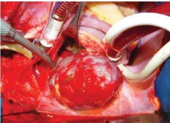 Fig. 1 - Aspecto intra-operatório da neoplasia após abertura atrial